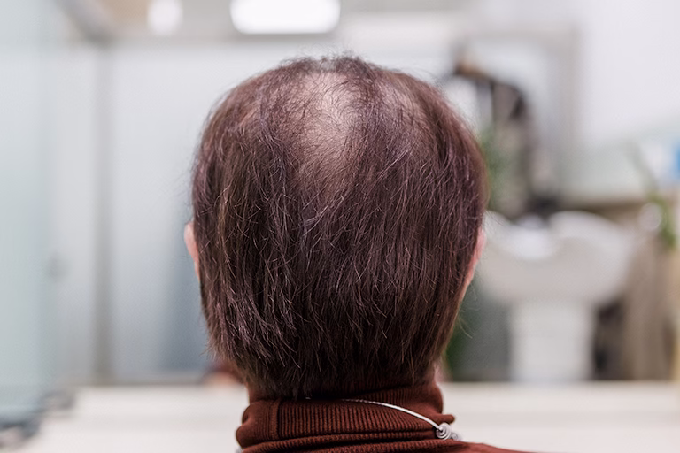 La Escala de Ludwig - Los 3 grados de la alopecia femenina