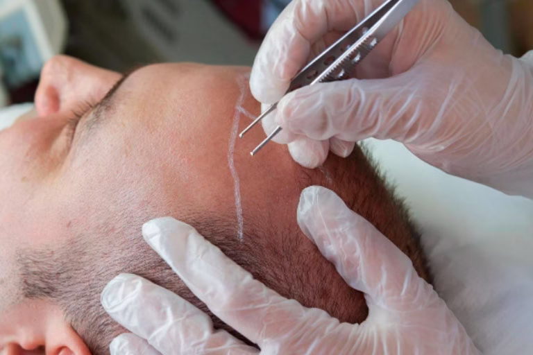 Los 5 errores más comunes sobre los implantes capilares