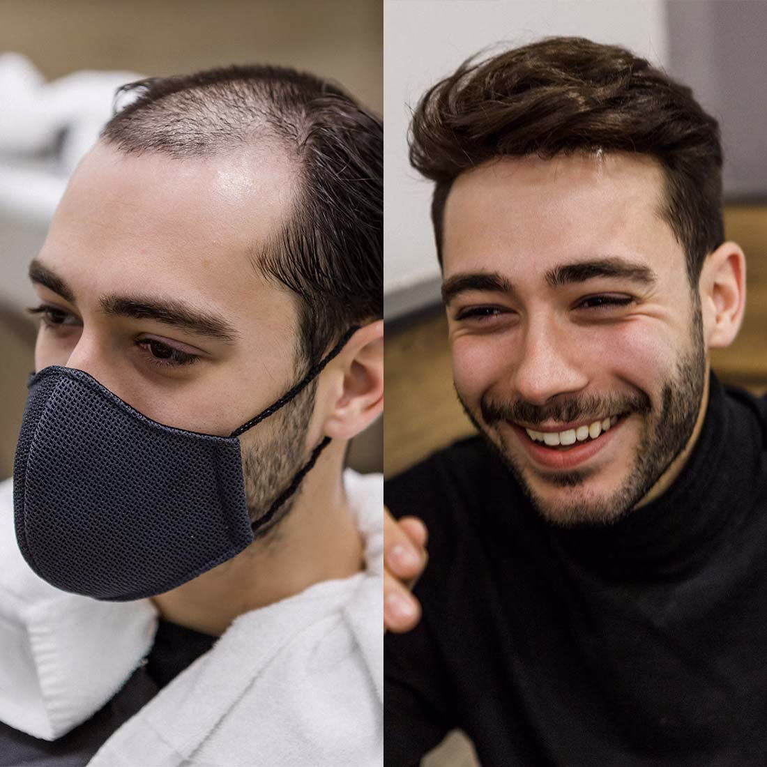 Prótesis capilar para hombre, cómo se pone