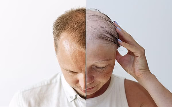 Pérdida de pelo: Diferencias entre la alopecia femenina y masculina que debes conocer