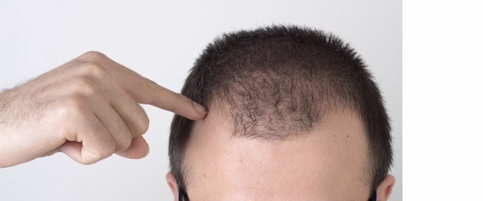 Primeros signos de la alopecia