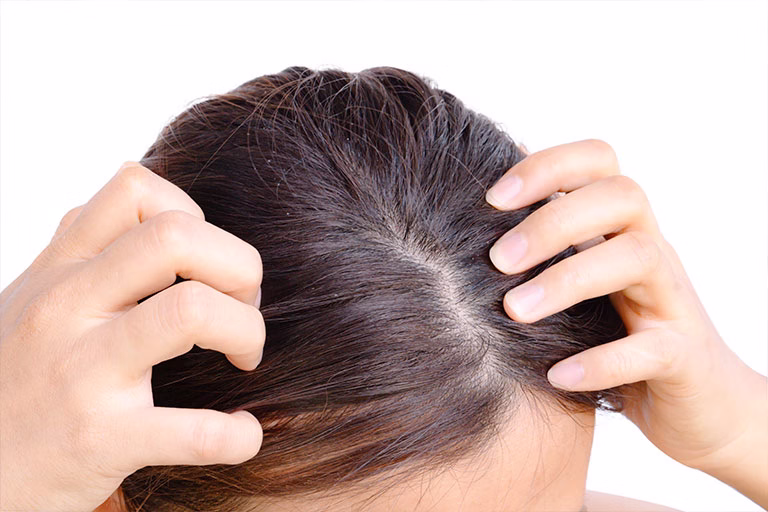 ¿Qué relación hay entre caspa y alopecia?