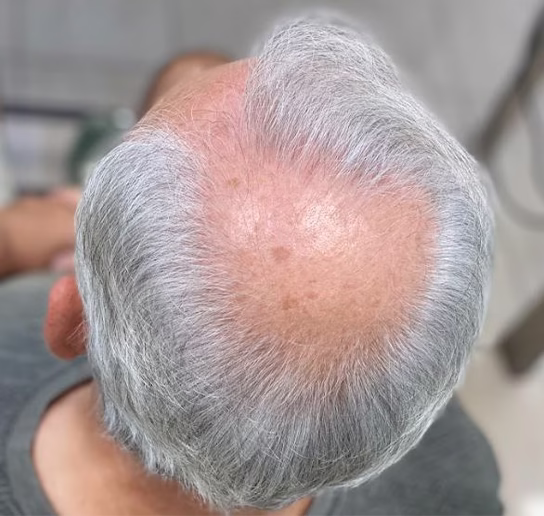 protesis-capilar-antes