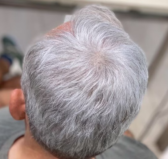 protesis-capilar-despues